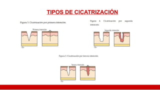 TIPOS DE CICATRIZACIÓN
 