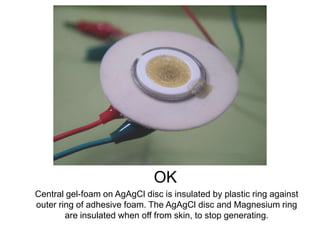 OK
Central gel-foam on AgAgCl disc is insulated by plastic ring against
outer ring of adhesive foam. The AgAgCl disc and Magnesium ring
are insulated when off from skin, to stop generating.
 