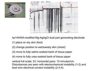 hp14445A modified Mg-AgAgCl dual part generating electrode
(1) place on dry skin (foot)
(2) change position to wet/sweaty skin (chest)
(3) move to fully saline soaked bank of tissue paper
(4) move to fully urea soaked bank of tissue paper
vertical full scale: 2V, horizontal pace: 10 minutes/cm.
Disturbances are seen with electrochemical instability (1-2) and
lead wire electrical contact instability (2-3-4).
 