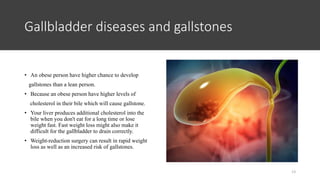 ramadan fasting gallstones