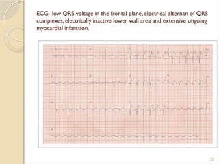 22
ECG- low QRS voltage in the frontal plane, electrical alternan of QRS
complexes, electrically inactive lower wall area and extensive ongoing
myocardial infarction.
 