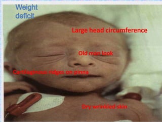 Dry wrinkled skin
Large head circumference
Old man look
Cartilaginous ridges on pinna
 