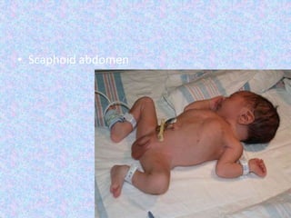 • Scaphoid abdomen
 