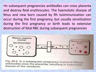 •In subsequent pregnancies antibodies can cross placenta
and destroy fetal erythrocytes. The haemolytic disease of
fetus and new born caused by Rh isoimmunisation can
occur during the first pregnancy, but usually sensitisation
during the first pregnancy or birth leads to extensive
destruction of fetal RBC during subsequent pregnancies
 