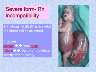 1- Hydrops fetalis (Massive fetal
red blood cell destruction).
It causes
anemiaFetal heart
failure Death of the infant
shortly after delivery.
 