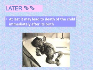 • At last it may lead to death of the child
immediately after its birth
 