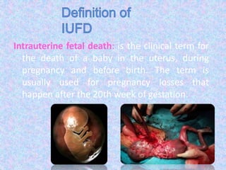 Intrauterine fetal death: is the clinical term for
the death of a baby in the uterus, during
pregnancy and before birth. The term is
usually used for pregnancy losses that
happen after the 20th week of gestation.
 