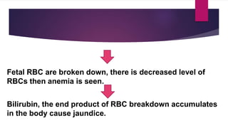 Fetal RBC are broken down, there is decreased level of
RBCs then anemia is seen.
Bilirubin, the end product of RBC breakdown accumulates
in the body cause jaundice.
 