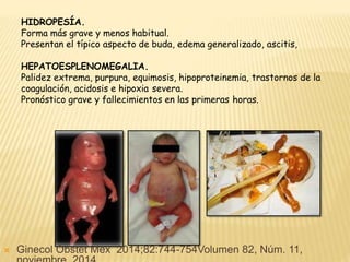 HIDROPESÍA.
Forma más grave y menos habitual.
Presentan el típico aspecto de buda, edema generalizado, ascitis,
HEPATOESPLENOMEGALIA.
Palidez extrema, purpura, equimosis, hipoproteinemia, trastornos de la
coagulación, acidosis e hipoxia severa.
Pronóstico grave y fallecimientos en las primeras horas.
 Ginecol Obstet Mex 2014;82:744-754Volumen 82, Núm. 11,
 