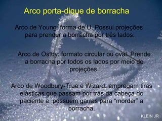 Arco de Young: forma de U. Possui projeções  para prender a borracha por três lados. Arco de Ostby: formato circular ou oval. Prende a borracha por todos os lados por meio de projeções. Arco de Woodbury-True e Wizard: empregam tiras elásticas que passam por trás da cabeça do paciente e  possuem garras para “morder” a borracha. Arco porta-dique de borracha KLEIN JR 
