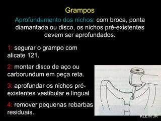 1:  segurar o grampo com alicate 121. 2:  montar disco de aço ou carborundum em peça reta. 3:  aprofundar os nichos pré-existentes vestibular e lingual 4:  remover pequenas rebarbas residuais. Grampos Aprofundamento dos nichos:  com broca, ponta diamantada ou disco, os nichos pré-existentes devem ser aprofundados. KLEIN JR 