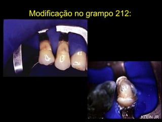 Modificação no grampo 212: KLEIN JR 