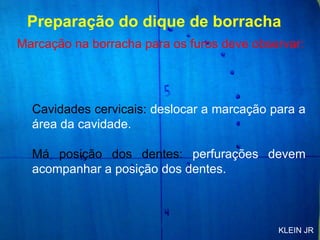 Cavidades cervicais:  deslocar a marcação para a área da cavidade.  Má posição dos dentes:  perfurações devem acompanhar a posição dos dentes. Preparação do dique de borracha Marcação na borracha para os furos deve observar: KLEIN JR 