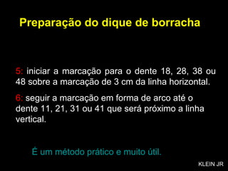 5:  iniciar a marcação para o dente 18, 28, 38 ou 48 sobre a marcação de 3 cm da linha horizontal. 6:  seguir a marcação em forma de arco até o dente 11, 21, 31 ou 41 que será próximo a linha vertical. É um método prático e muito útil. Preparação do dique de borracha KLEIN JR 