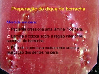Preparação do dique de borracha Mordida em cera: 1:  Paciente pressiona uma lâmina 7 de cera. 2:  Lâmina é coloca sobre a região inferior ou superior  da borracha. 3:  Fura-se a borracha exatamente sobre a marcação dos dentes na cera. KLEIN JR 