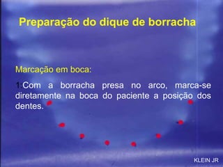 Marcação em boca: 1: Com a borracha presa no arco, marca-se diretamente na boca do paciente a posição dos dentes. Preparação do dique de borracha KLEIN JR 
