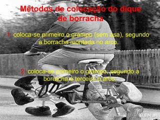 Métodos de colocação do dique de borracha 1:  coloca-se primeiro o grampo (sem asa), segundo  a borracha montada no arco. 2:  coloca-se primeiro o grampo, segundo a borracha e terceiro o arco. KLEIN JR 