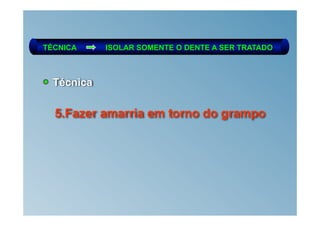 TÉCNICA     ISOLAR SOMENTE O DENTE A SER TRATADO



  Técnica

  5.Fazer amarria em torno do grampo
 