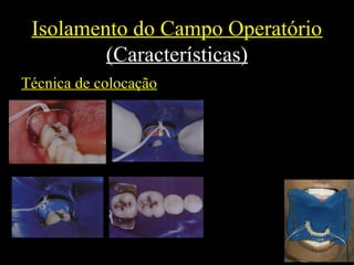 Isolamento do Campo Operatório
(Características)
Técnica de colocação
 