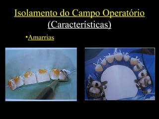 Isolamento do Campo Operatório
(Características)
•Amarrias
 