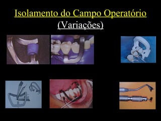 Isolamento do Campo Operatório
(Variações)
 