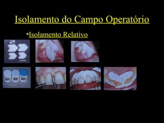 Isolamento do Campo Operatório
•Isolamento Relativo
 