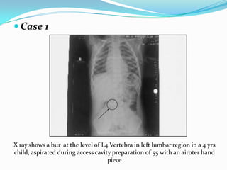  Case 1
X ray shows a bur at the level of L4 Vertebra in left lumbar region in a 4 yrs
child, aspirated during access cavity preparation of 55 with an airoter hand
piece
 