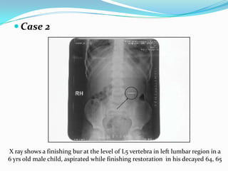  Case 2
X ray shows a finishing bur at the level of L5 vertebra in left lumbar region in a
6 yrs old male child, aspirated while finishing restoration in his decayed 64, 65
 