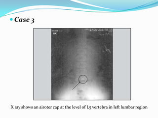  Case 3
X ray shows an airoter cap at the level of L5 vertebra in left lumbar region
 
