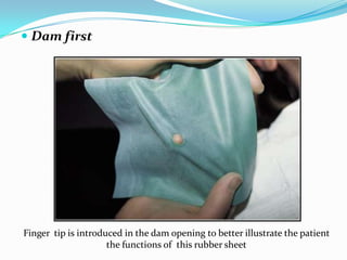  Dam first
Finger tip is introduced in the dam opening to better illustrate the patient
the functions of this rubber sheet
 