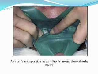 Assistant’s hands position the dam directly around the tooth to be
treated
 