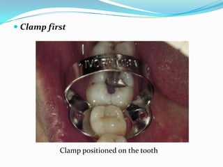  Clamp first
Clamp positioned on the tooth
 