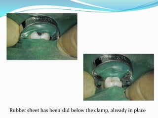 Rubber sheet has been slid below the clamp, already in place
 