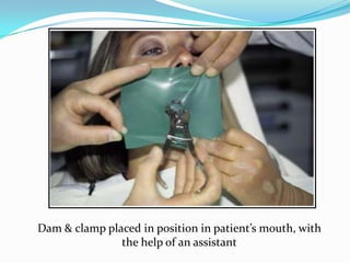 Dam & clamp placed in position in patient’s mouth, with
the help of an assistant
 