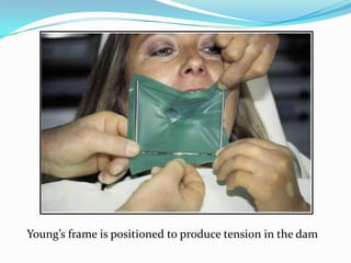 Young’s frame is positioned to produce tension in the dam
 