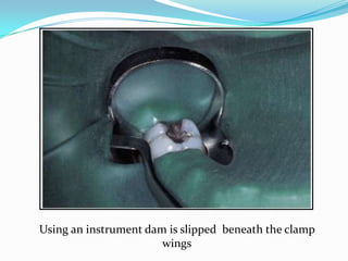 Using an instrument dam is slipped beneath the clamp
wings
 