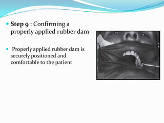  Step 9 : Confirming a
properly applied rubber dam
 Properly applied rubber dam is
securely positioned and
comfortable to the patient
 