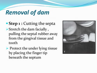 Removal of dam
 Step 1 : Cutting the septa
Stretch the dam facially ,
pulling the septal rubber away
from the gingival tissue and
tooth
 Protect the under lying tissue
by placing the finger tip
beneath the septum
 