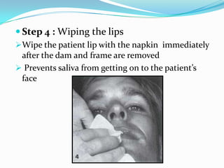  Step 4 : Wiping the lips
Wipe the patient lip with the napkin immediately
after the dam and frame are removed
 Prevents saliva from getting on to the patient’s
face
 