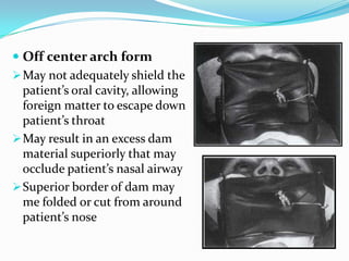  Off center arch form
May not adequately shield the
patient’s oral cavity, allowing
foreign matter to escape down
patient’s throat
May result in an excess dam
material superiorly that may
occlude patient’s nasal airway
Superior border of dam may
me folded or cut from around
patient’s nose
 