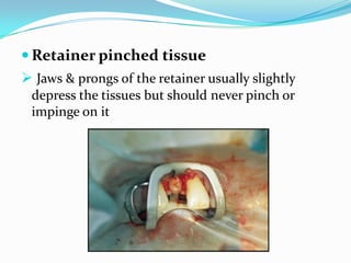  Retainer pinched tissue
 Jaws & prongs of the retainer usually slightly
depress the tissues but should never pinch or
impinge on it
 