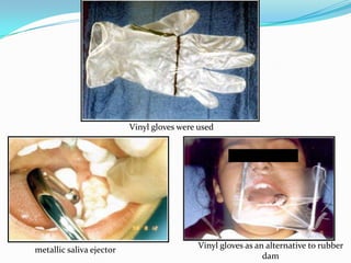 Vinyl gloves were used
Vinyl gloves as an alternative to rubber
dam
metallic saliva ejector
 