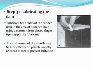  Step 4 : Selecting the
clamp
 operator receive the rubber dam
retainer forceps with the selected
retainer and floss tie...