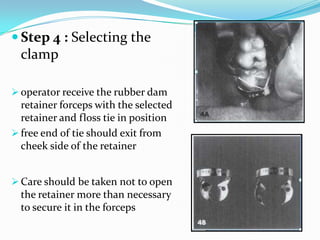  Step 5: Testing the retainers
stability and retention
 Test the retainers stability and
retention by lifting gently in ...