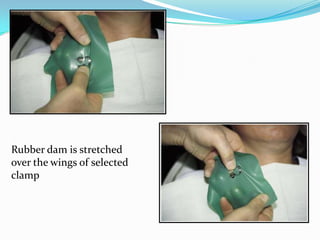 Dam & clamp placed in position in patient’s mouth, with
the help of an assistant
 