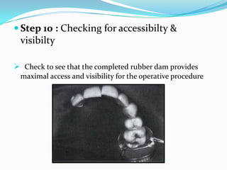 Removal of dam
 Step 1 : Cutting the septa
Stretch the dam facially ,
pulling the septal rubber away
from the gingival t...