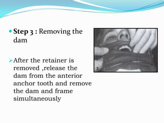  Step 4 : Wiping the lips
Wipe the patient lip with the napkin immediately
after the dam and frame are removed
 Prevent...