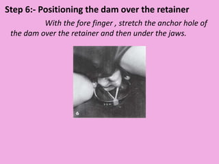 Step 6:- Positioning the dam over the retainer
With the fore finger , stretch the anchor hole of
the dam over the retainer and then under the jaws.
 