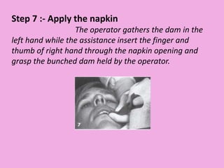 Step 7 :- Apply the napkin
The operator gathers the dam in the
left hand while the assistance insert the finger and
thumb of right hand through the napkin opening and
grasp the bunched dam held by the operator.
 