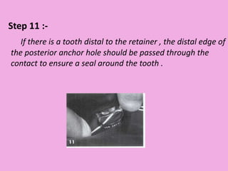Step 11 :-
If there is a tooth distal to the retainer , the distal edge of
the posterior anchor hole should be passed through the
contact to ensure a seal around the tooth .
 